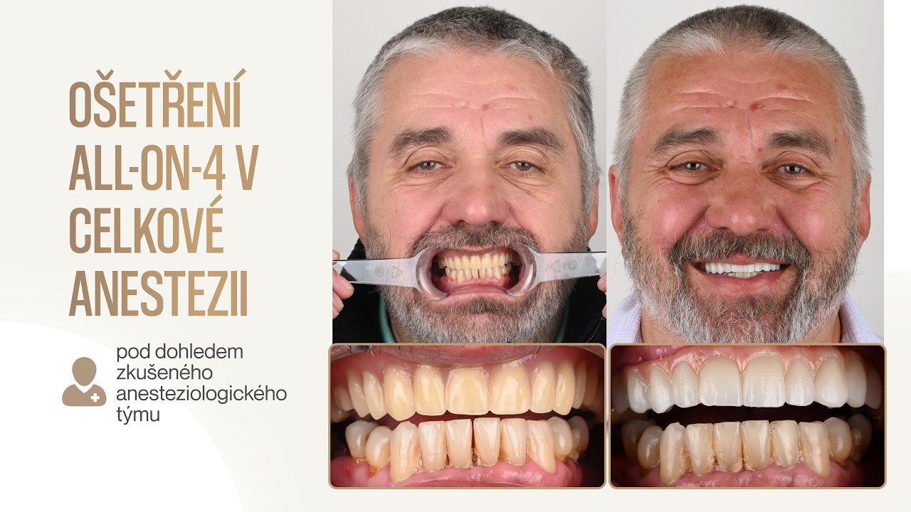 All-on-4 očima pacienta: skutečný příběh a proměna úsměvu