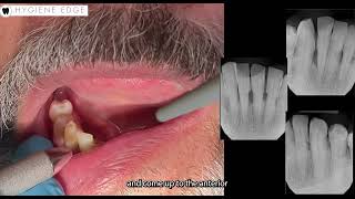 How to check for mobility on a patient with periodontitis