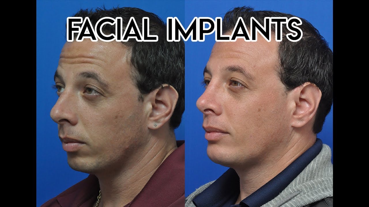 Facial Implants