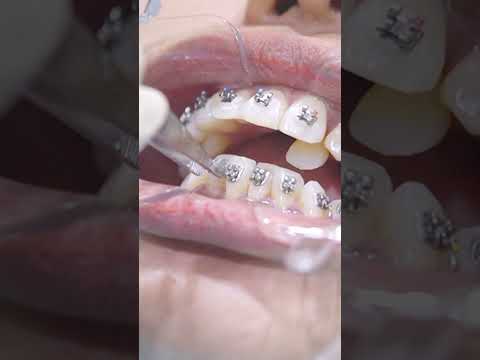 PROSES PEMASANGAN BEHEL