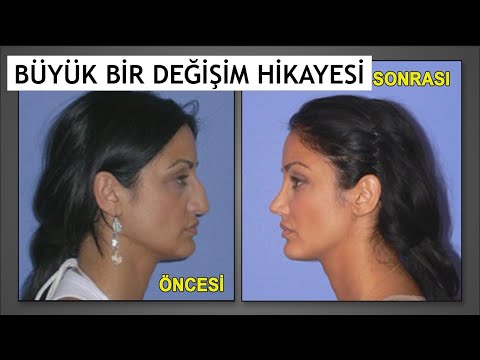 BÜYÜK BİR DEĞİŞİM HİKAYESİ - ESTETİK MUCİZESİ
