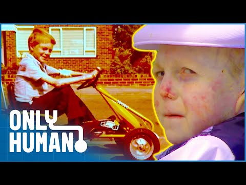 The Boy Whose Skin Fell Off | Medical Documentary | Only Human