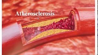 Role of oxidative stress in atherosclerosis
