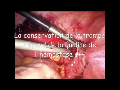 comment soigner une grossesse extra uterine