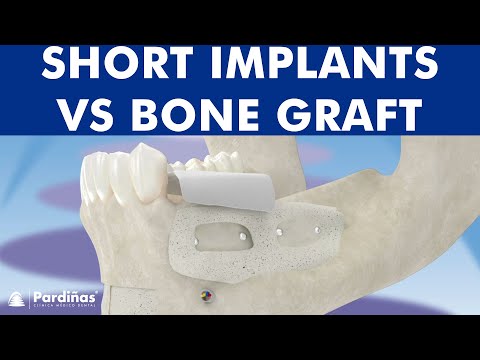 Short implants and bone augmentation ©