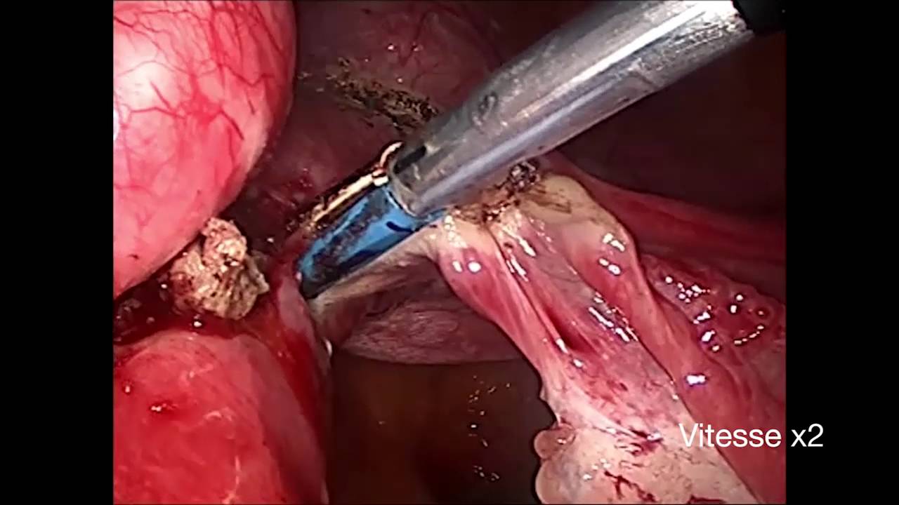 Hysterectomie par coelioscopie dr criscuolo jean louis clinique des landes mp4
