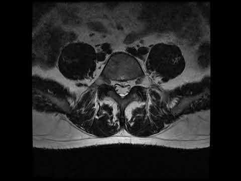 Ob der Hals mit Osteochondrose erhöhen Schmerzen Kopf von zervikaler degenerativer Scheibenerkrankung