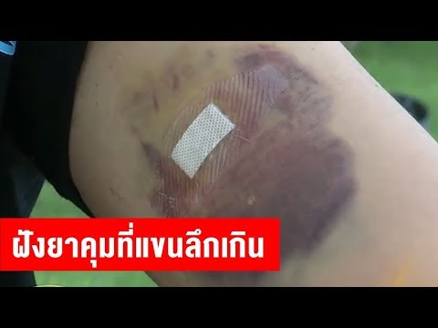 อย่านำกองทัพกับโรคสะเก็ดเงินในยูเครน โรคสะเก็ดเงินที่เล็บวิธีที่จะหยุด