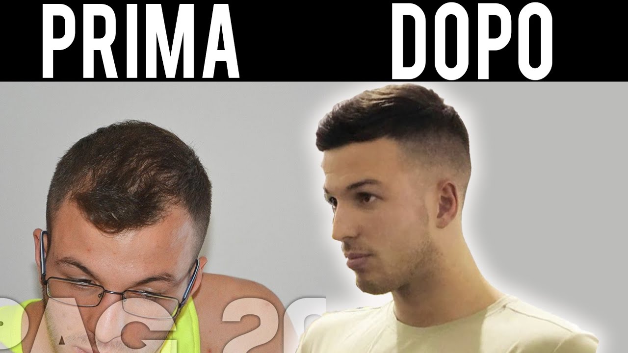 PERDI I CAPELLI TI AIUTO IO - ALOPECIA ANDROGENETICA (la mia esperienza)