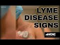 Do you know the signs of Lyme disease?