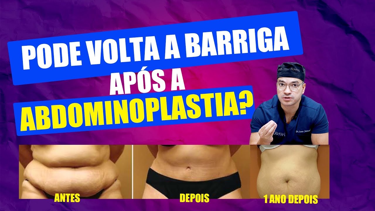 QUEM FAZ ABDOMINOPLASTIA PODE VOLTAR A TER BARRIGA? I Cirurgia Plástica