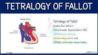 Tetralogy of Fallot (TOF) Explained