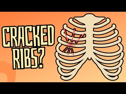 Cracked & Broken Ribs: Symptoms, Treatment, & Recovery Time.