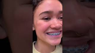 Here is what baby blue colored braces ties look like on someone