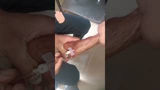 Cannulation video part 1041 #shorts #viral