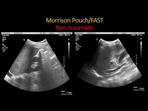 Ultrasound in children presented with shock