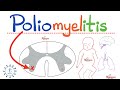 Poliomyelitis Paralysis Anterior Horn Cell AHC Disease Hypotonia Weakness Neurology