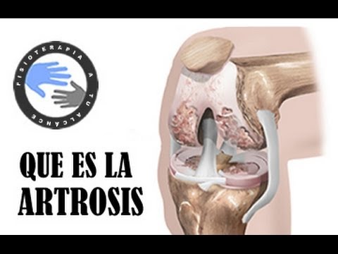 Que es la artrosis y como se produce