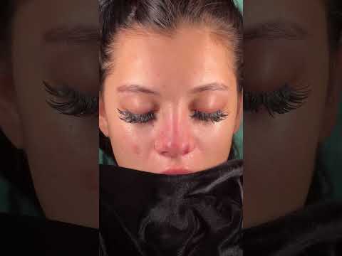 Revision Rhinoplasty From Germany. She had rhinoplasty 2 times before... #rhinoplastyturkey