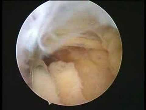 Arthroscopic Ostophyte Bone Excision In Elbow