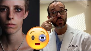Black Eye - Patient Education Video - Dr. Carlo Oller