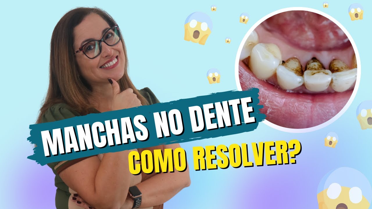 Como acabar com as manchas nos dentes? Adornare Odontologia Estética em Santos