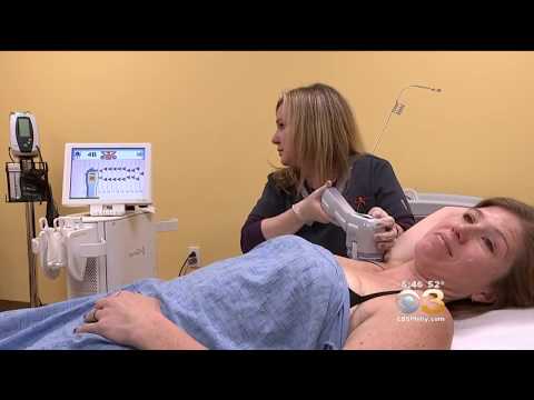 miraDry- A Solution For Underarm Sweat, Philadelphia- Dr. Ringpfeil CBS3 News