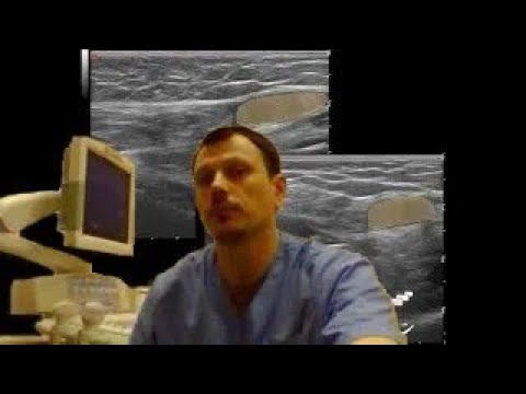 Pediatric Soft tissue ultrasound - Testicle in the anterior abdominal wall