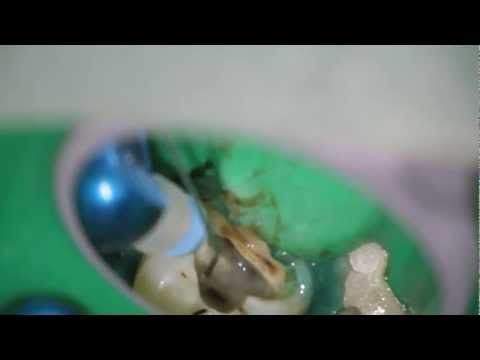  Endodontic Treatment with the use of Hand Files