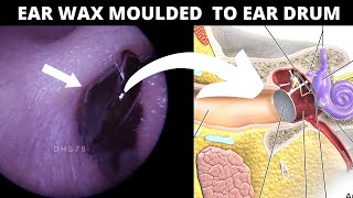Black Ear Wax Moulded To Surface Of Eardrum
