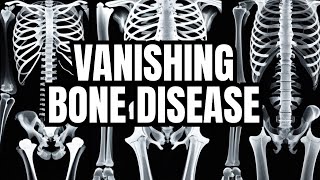 Gorham-Stout disease/ vanishing bone disease/ disappearing bone disease/ phantom bone disease