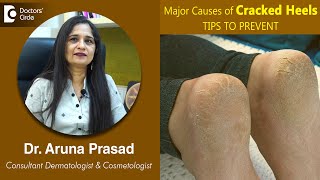 Major Tips to Prevent CRACKED HEELS | Fissure Feet | Cuts in Feet -Dr.Aruna Prasad| Doctors
