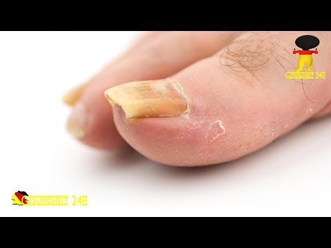 Die Salbe von gribka chinesisch für die Nägel Tut den Winkel des Nagels auf dem Daumen des Beines die Behandlung weh