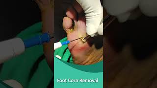 Download lagu Foot Corn Removal #shorts mp3 Download lagu Foot Corn Removal #shorts mp3