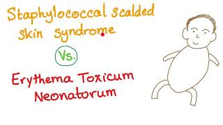 Staphylococcal Scalded Skin Syndrome V.S. Erythema Toxicum Neonatorum