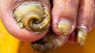 Onychomycosis Is Like A Spiral Staircase  Cut Off The Bad Nails【Xue Yidao】