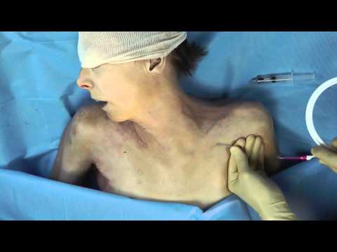 Central Line - Subclavian infraclavicular approach