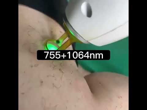 λειζερ  Αλεξανδριτη-thumb-1