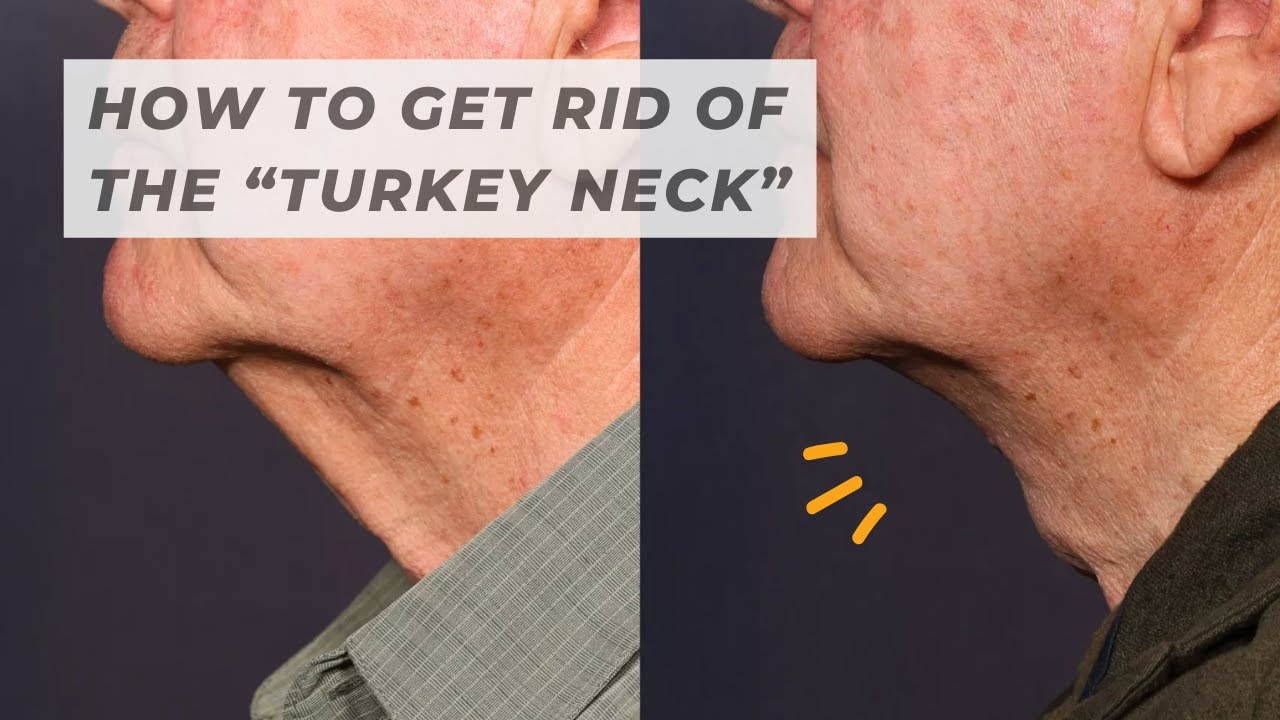Bye-Bye, Turkey Neck: What Is The T-Z Plasty and Who Is It For?