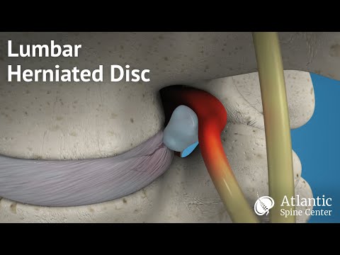 Lumbar Herniated Disc Anatomy