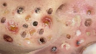 Loan Nguyen Acne Treatment 9.