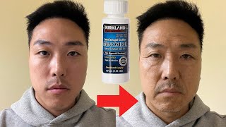 DOES MINOXIDIL CAUSE SKIN AGING AND WRINKLES