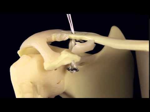 Double Endobutton Technique