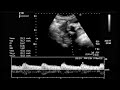 8 weeks fetal heart rate - ultrasound