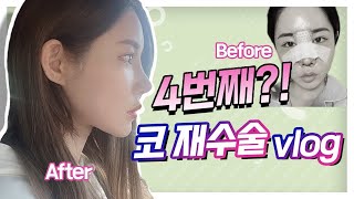 민효린 코가 되고 싶어 4번째 코재수술 V-log 2분 요약본#코재수술 #코재수술성형외과