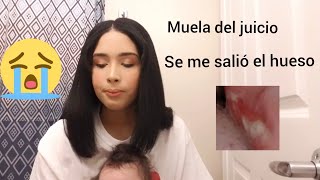 MUELA DEL JUICIO EXTRACCIÓN MI EXPERIENCIA *SE ME SALIO EL HUESO*😭😱 *