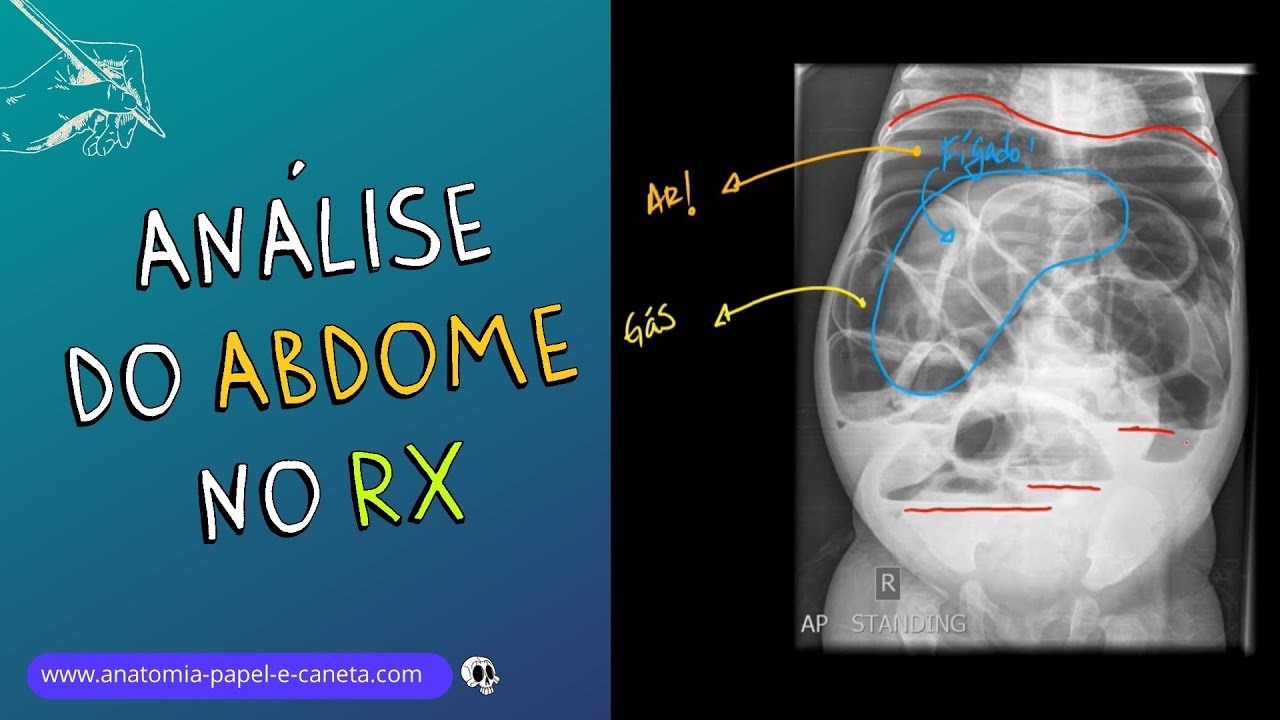 Aprenda a analisar o exame de ABDOME no RX