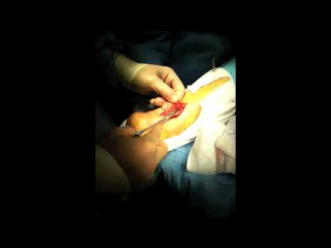 Achilles Tendon Repair Surgery