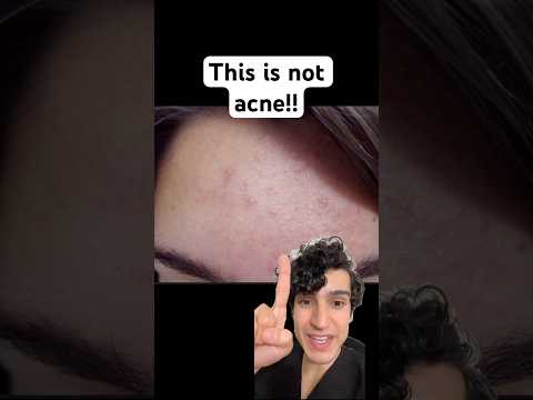 Derm explains what’s actually causing your forehead acne #acnetreatment #acnecauses #fungalacne