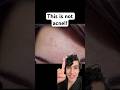 Derm explains what’s actually causing your forehead acne #acnetreatment #acnecauses #fungalacne
